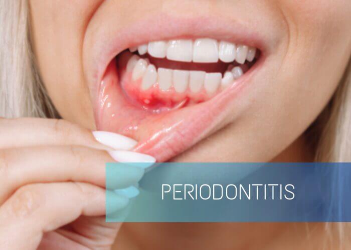 Nucia Clinic - Peridontitis asociada a un mayor riesgo de Cancer