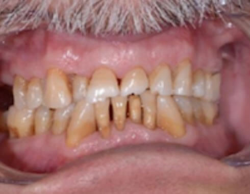 Nucia Clinic - Casos Estetica Dental - Imagen 1
