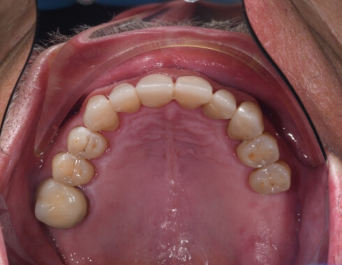 Nucia Clinic - Casos Estetica Dental - Imagen 10