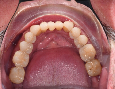 Nucia Clinic - Casos Estetica Dental - Imagen 11