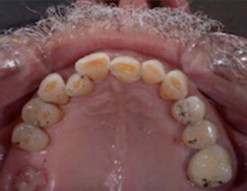 Nucia Clinic - Casos Estetica Dental - Imagen 2