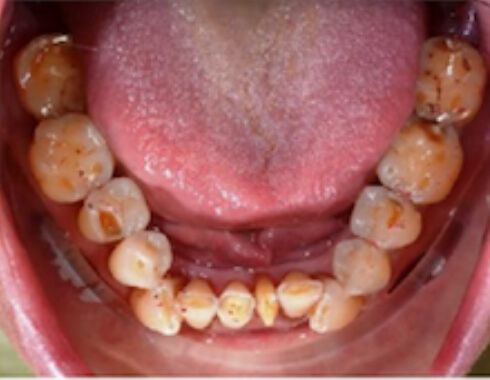 Nucia Clinic - Casos Estetica Dental - Imagen 3