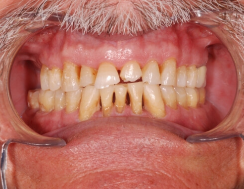 Nucia Clinic - Casos Estetica Dental - Imagen 4