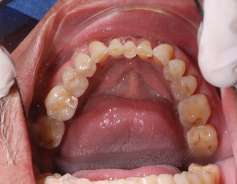 Nucia Clinic - Casos Estetica Dental - Imagen 6