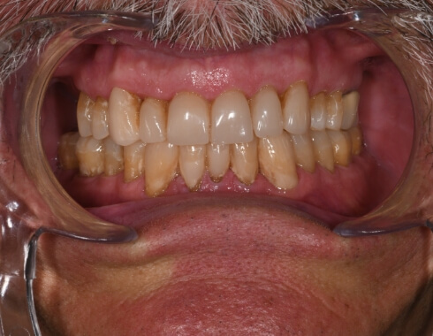 Nucia Clinic - Casos Estetica Dental - Imagen 7