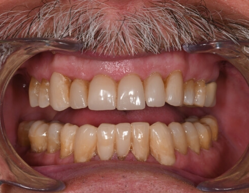 Nucia Clinic - Casos Estetica Dental - Imagen 8