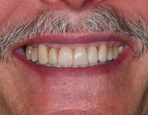 Nucia Clinic - Casos Estetica Dental - Imagen 9