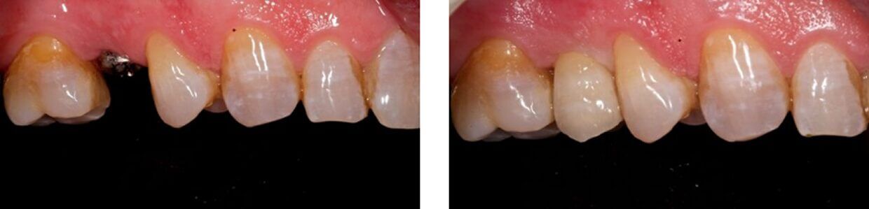 Nucia Clinic - Casos Implantes Dentales - Imagen 1