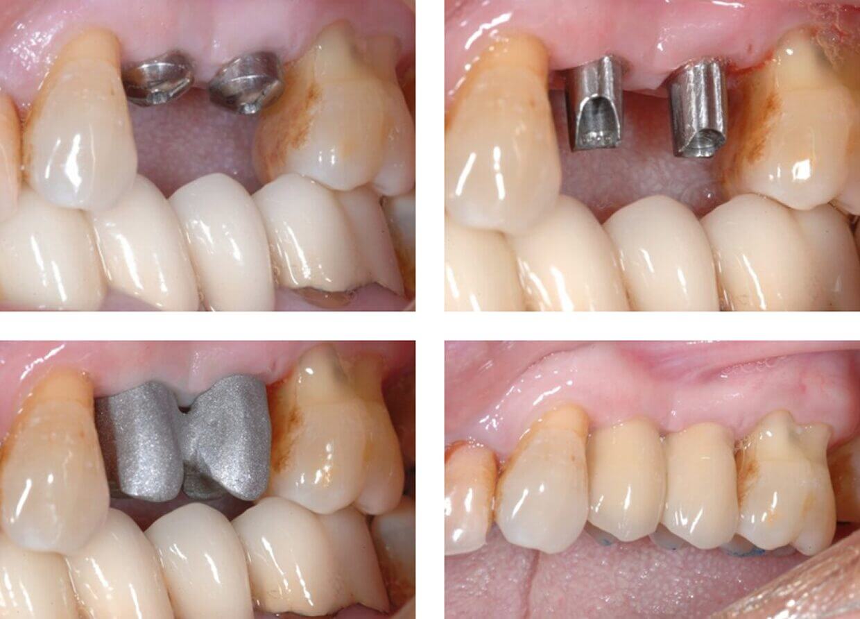 Nucia Clinic - Casos Implantes Dentales - Imagen 2