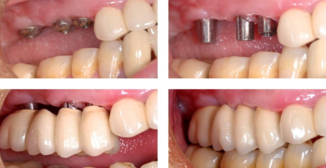 Nucia Clinic - Casos Implantes Dentales - Imagen 3