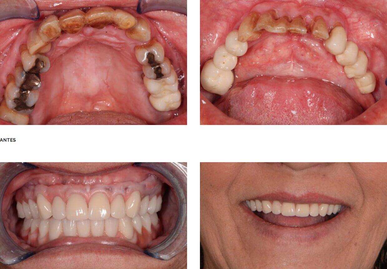 Nucia Clinic - Casos Implantes Dentales - Imagen 4