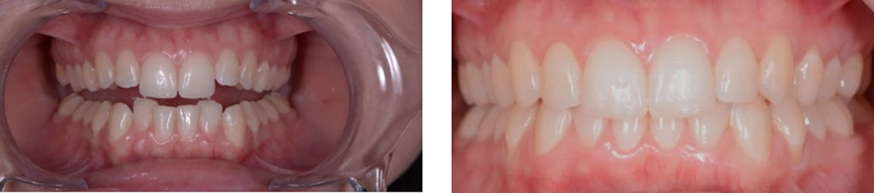 Nucia Clinic - Casos Invisalign - Imagen 1