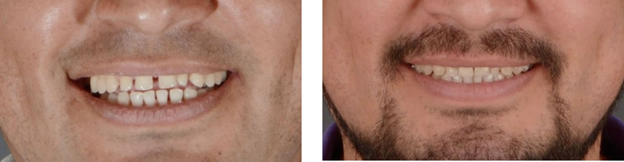Nucia Clinic - Casos Invisalign - Imagen 2