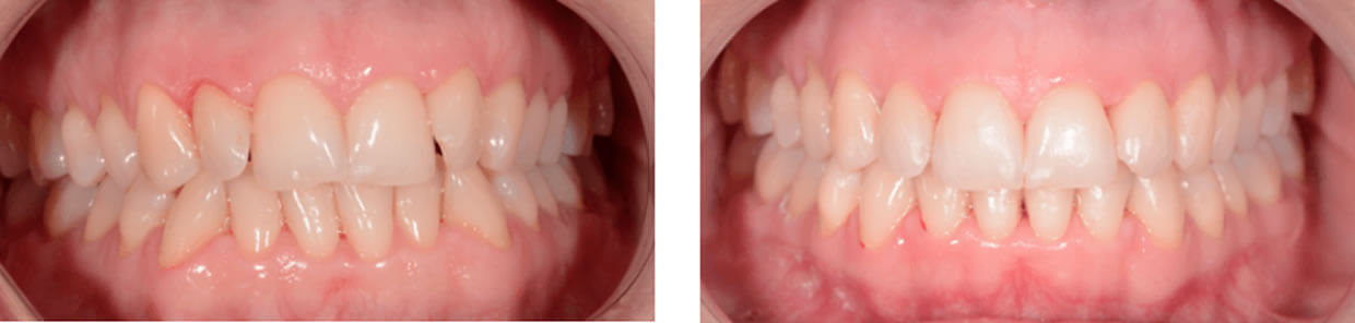 Nucia Clinic - Casos Invisalign - Imagen 3