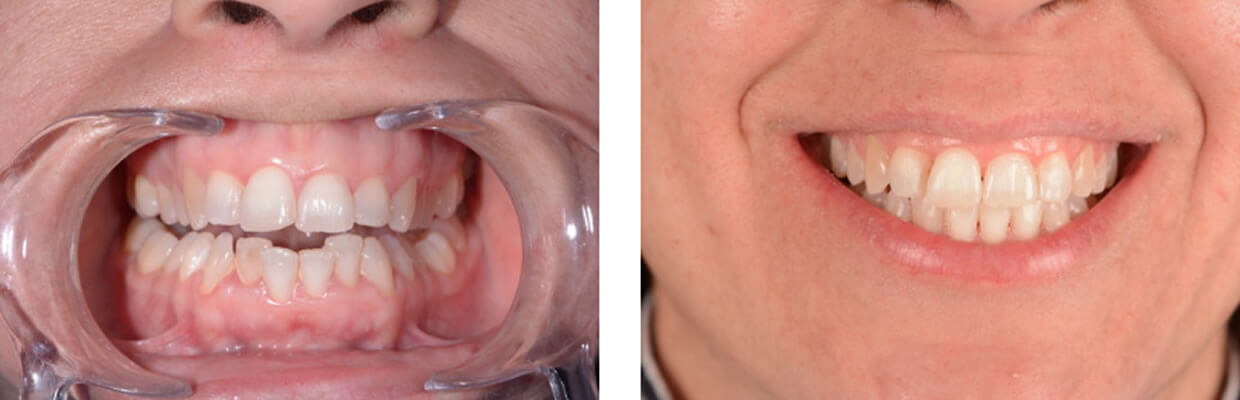 Nucia Clinic - Casos Invisalign - Imagen 4