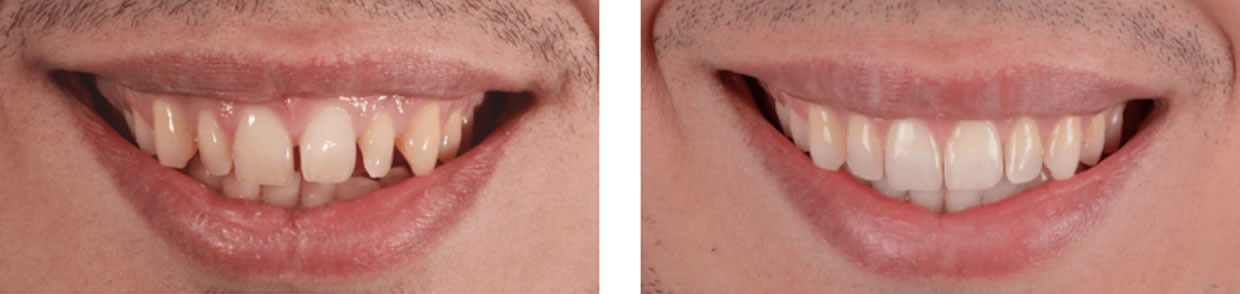 Nucia Clinic - Casos Invisalign - Imagen 5