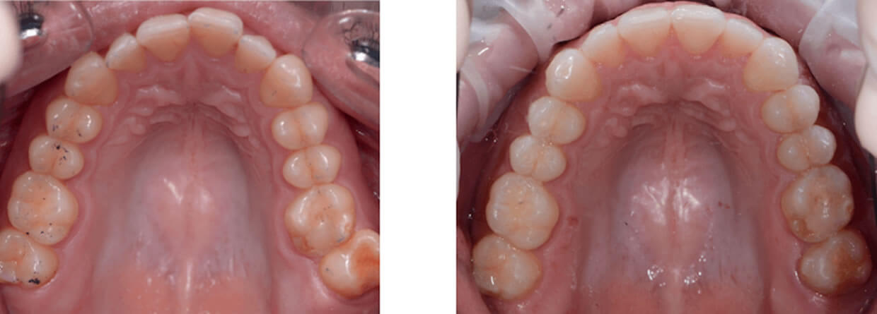 Nucia Clinic - Casos Invisalign - Imagen 7a