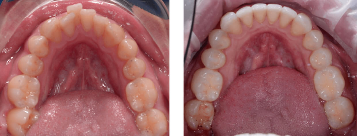 Nucia Clinic - Casos Invisalign - Imagen 7b