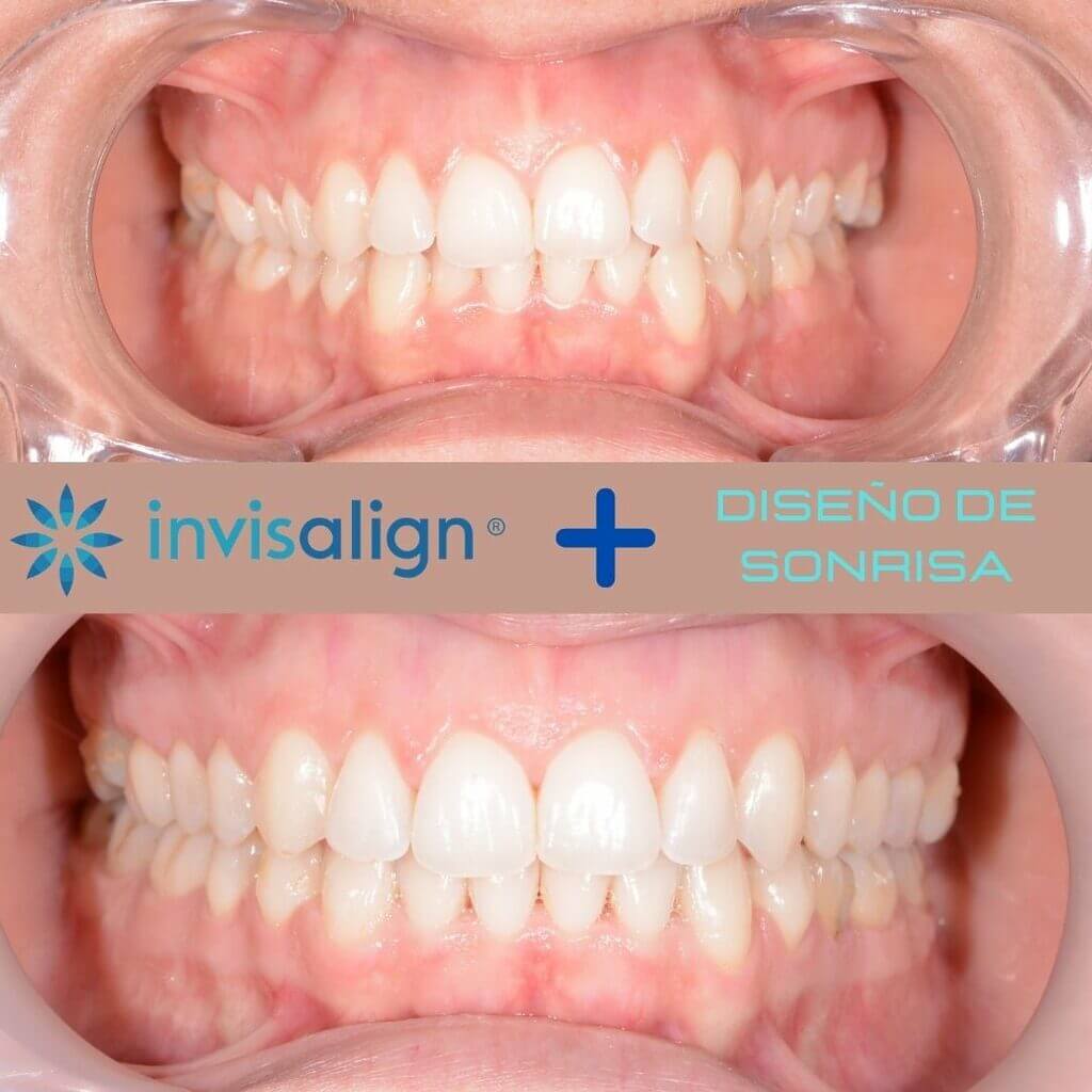 Nucia Clinic - Casos Invisalign - Imagen 8a