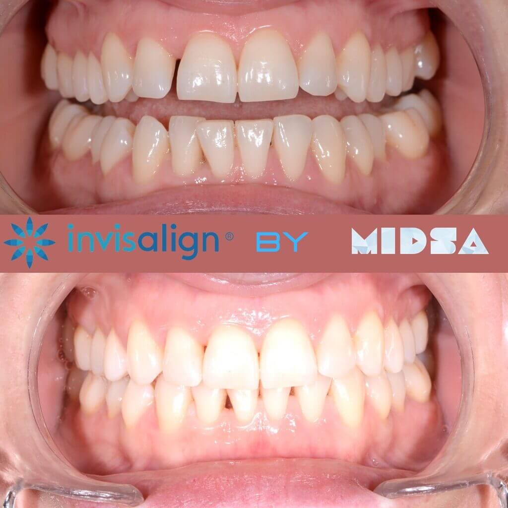 Nucia Clinic - Casos Invisalign - Imagen 8b