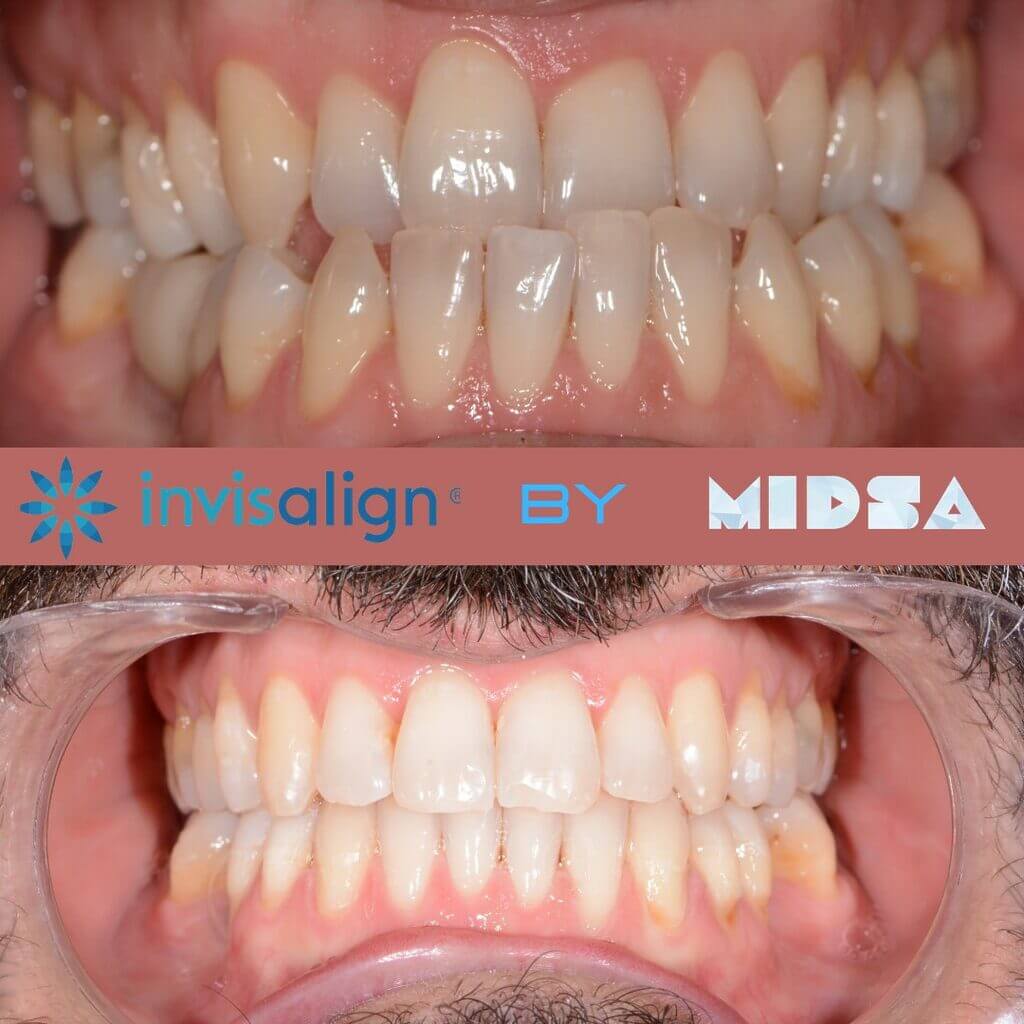 Nucia Clinic - Casos Invisalign - Imagen 8c