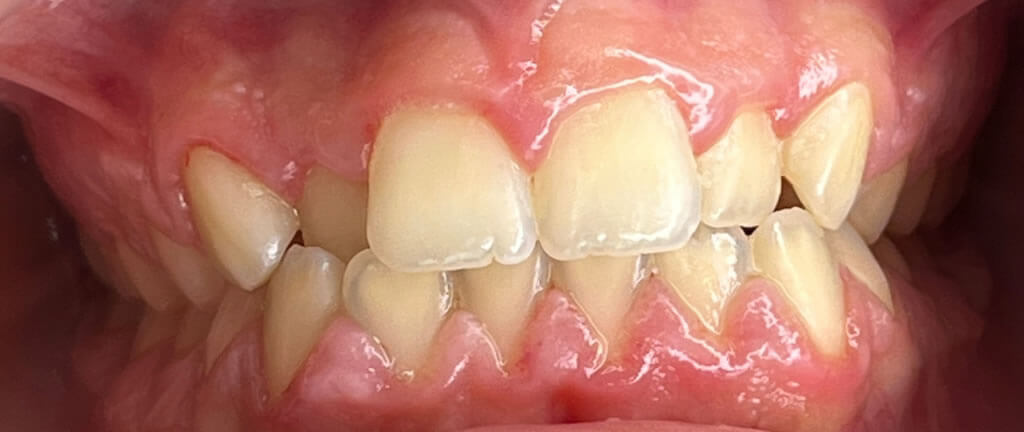 Nucia Clinic - Casos Invisalign - Imagen 10a