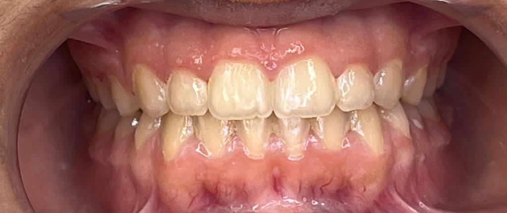 Nucia Clinic - Casos Invisalign - Imagen 10b