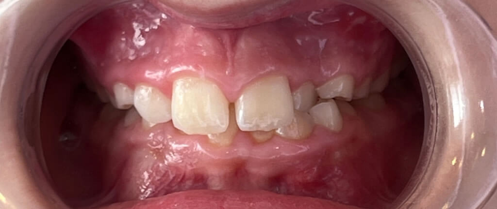 Nucia Clinic - Casos Invisalign - Imagen 11a