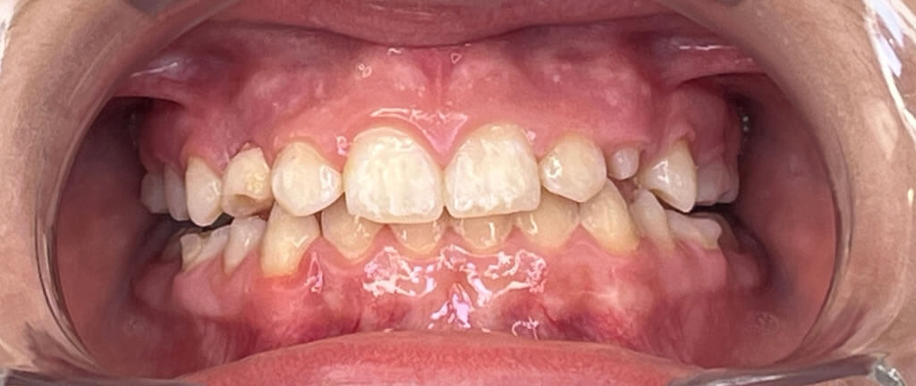 Nucia Clinic - Casos Invisalign - Imagen 11b