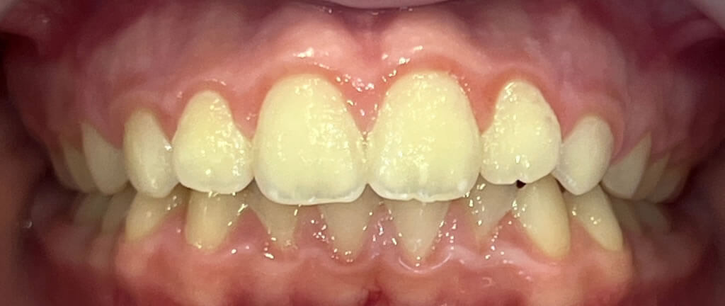 Nucia Clinic - Casos Invisalign - Imagen 12a