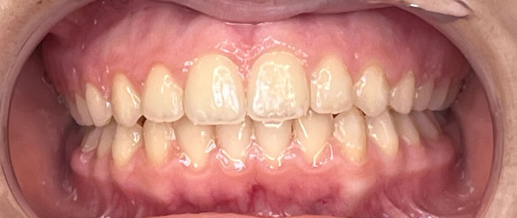 Nucia Clinic - Casos Invisalign - Imagen 12b