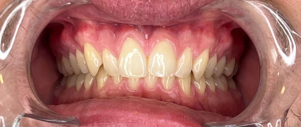 Nucia Clinic - Casos Invisalign - Imagen 13a