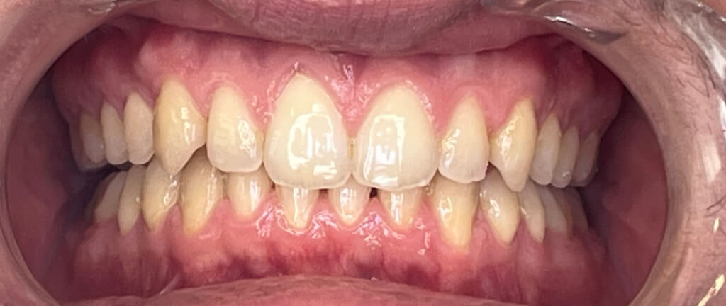 Nucia Clinic - Casos Invisalign - Imagen 13b