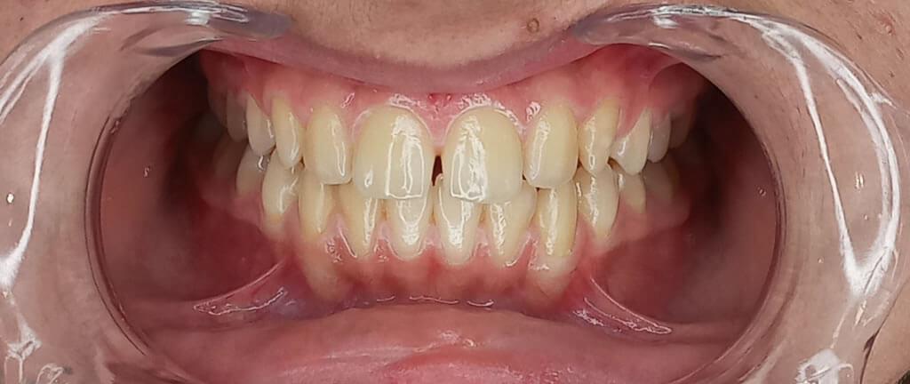 Nucia Clinic - Casos Invisalign - Imagen 14a