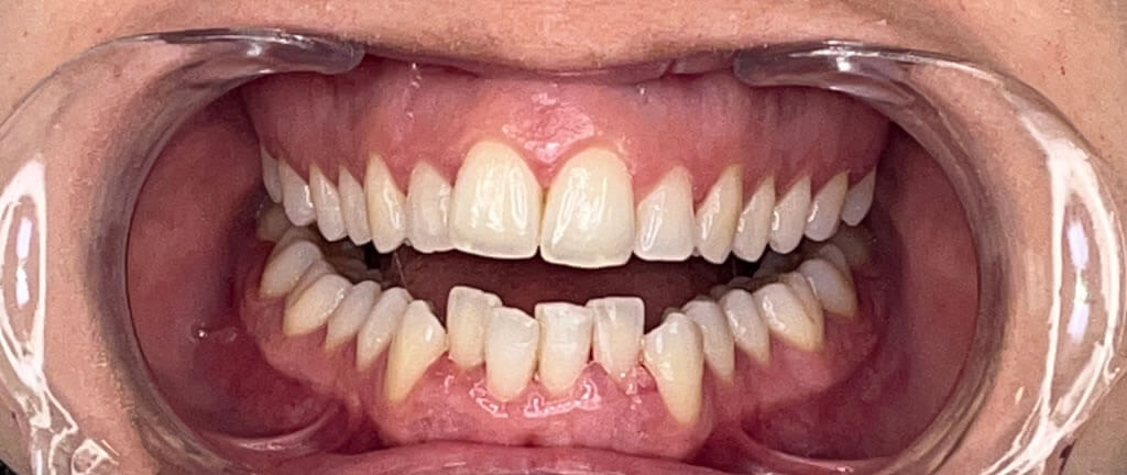 Nucia Clinic - Casos Invisalign - Imagen 9a