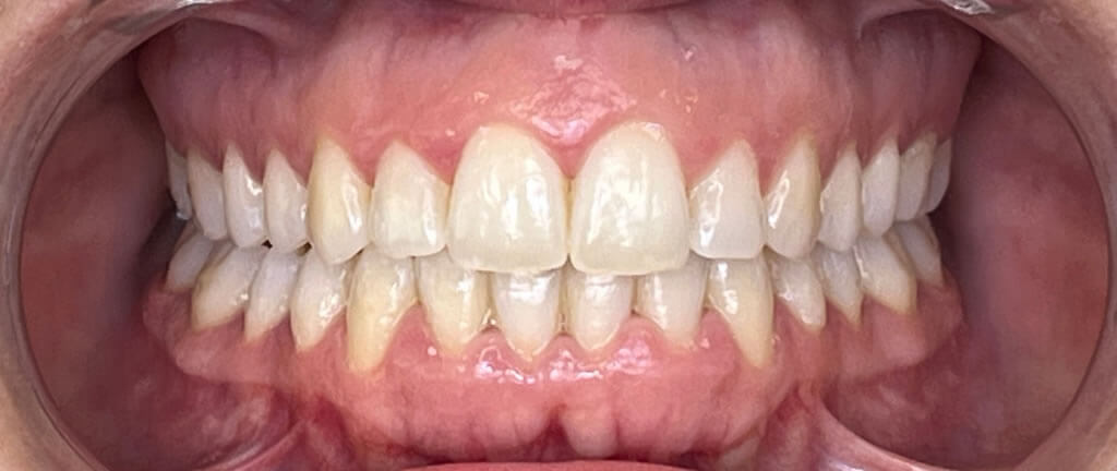 Nucia Clinic - Casos Invisalign - Imagen 9b